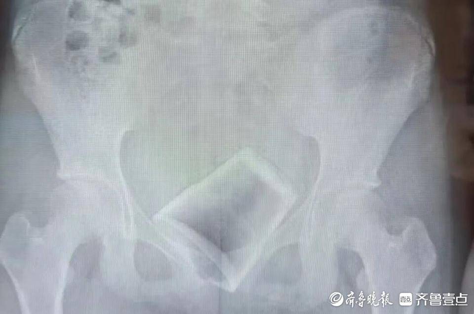 12岁男孩下体插着电线就诊<strong></p>
<p>中币交易所如何登录</strong>！医生：这些尿道异物要注意