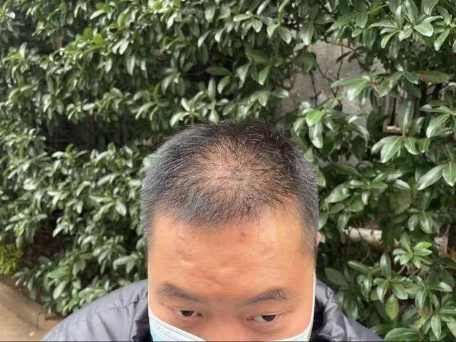 “还能反光<strong></p>
<p>pai币在哪个交易所上线</strong>！”长沙男子植发近9月称后脑勺“像狗啃过”