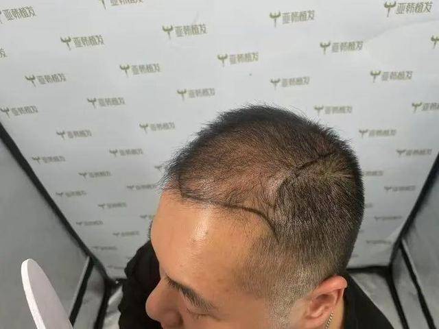 “还能反光<strong></p>
<p>pai币在哪个交易所上线</strong>！”长沙男子植发近9月称后脑勺“像狗啃过”