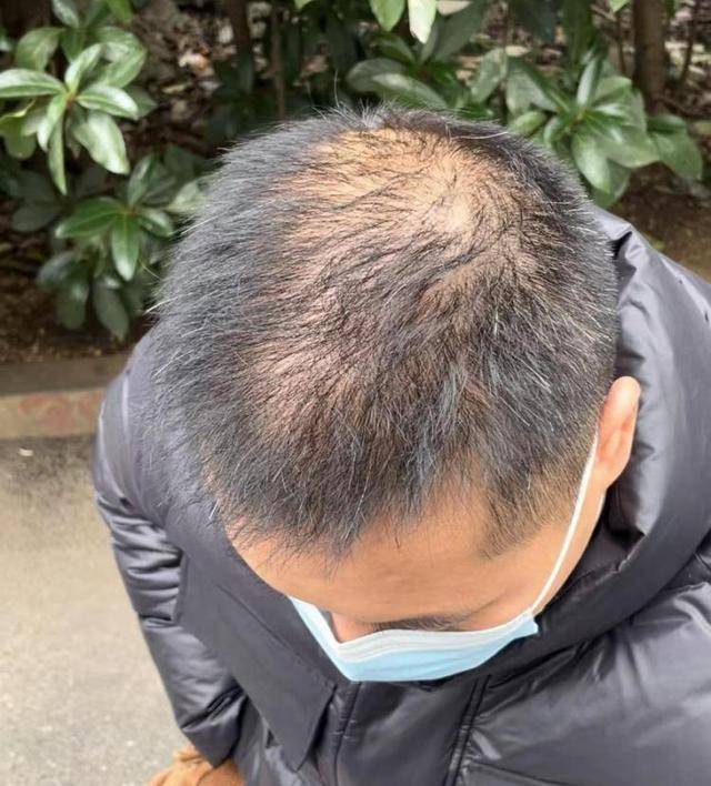 “还能反光<strong></p>
<p>pai币在哪个交易所上线</strong>！”长沙男子植发近9月称后脑勺“像狗啃过”