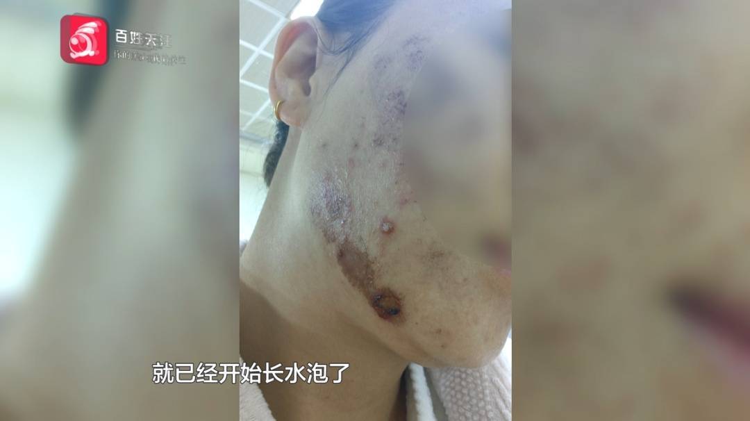 “顶着这张脸<strong></p>
<p>pai币在哪个交易所上线</strong>，我能去哪里”？贵阳一女子激光祛痘印疑被烫伤，感觉是烧糊了...
