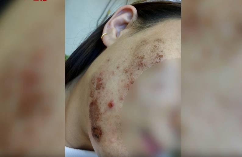 “顶着这张脸<strong></p>
<p>pai币在哪个交易所上线</strong>，我能去哪里”？贵阳一女子激光祛痘印疑被烫伤，感觉是烧糊了...