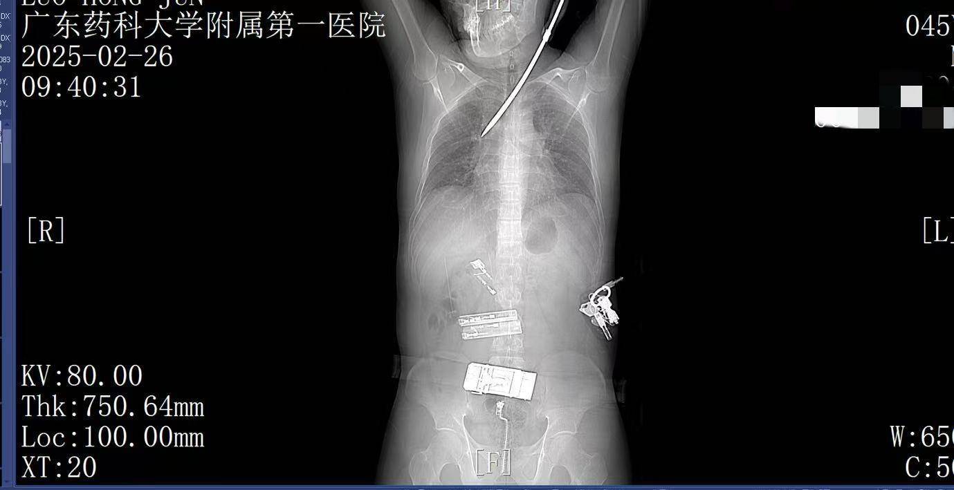 20米高空掉落螺丝刀直插男子胸腔<strong></p>
<p>币安交易所下载</strong>！医生：不要自行拔除