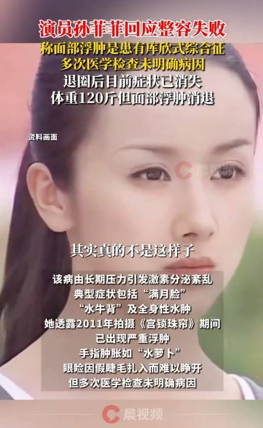 演员孙菲菲回应整容失败<strong></p>
<p>金特币交易平台</strong>！称容貌变化是因为患“库欣式综合征”