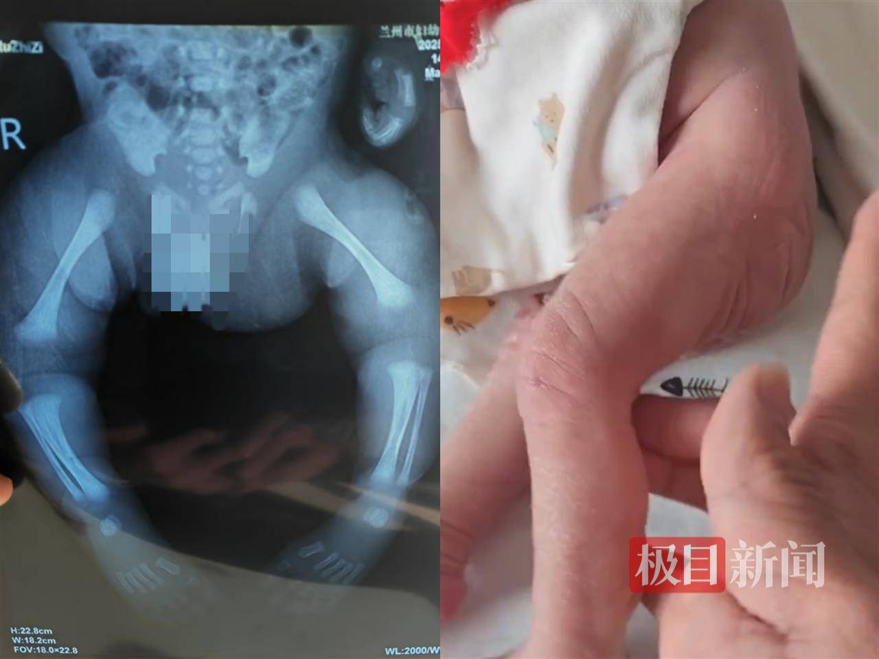 二胎出生查出先天性病症或落下残疾<strong></p>
<p>币币交易平台优势</strong>，残疾父母称医院产检漏检、未尽告知义务，医院及医调委回应