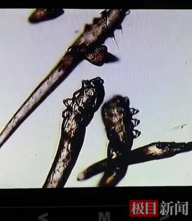 11岁女孩眼痒眼痛<strong></p>
<p>杭齿前进股票</strong>，竟是睫毛“养了”10条螨虫！医生：不良生活习惯是帮凶